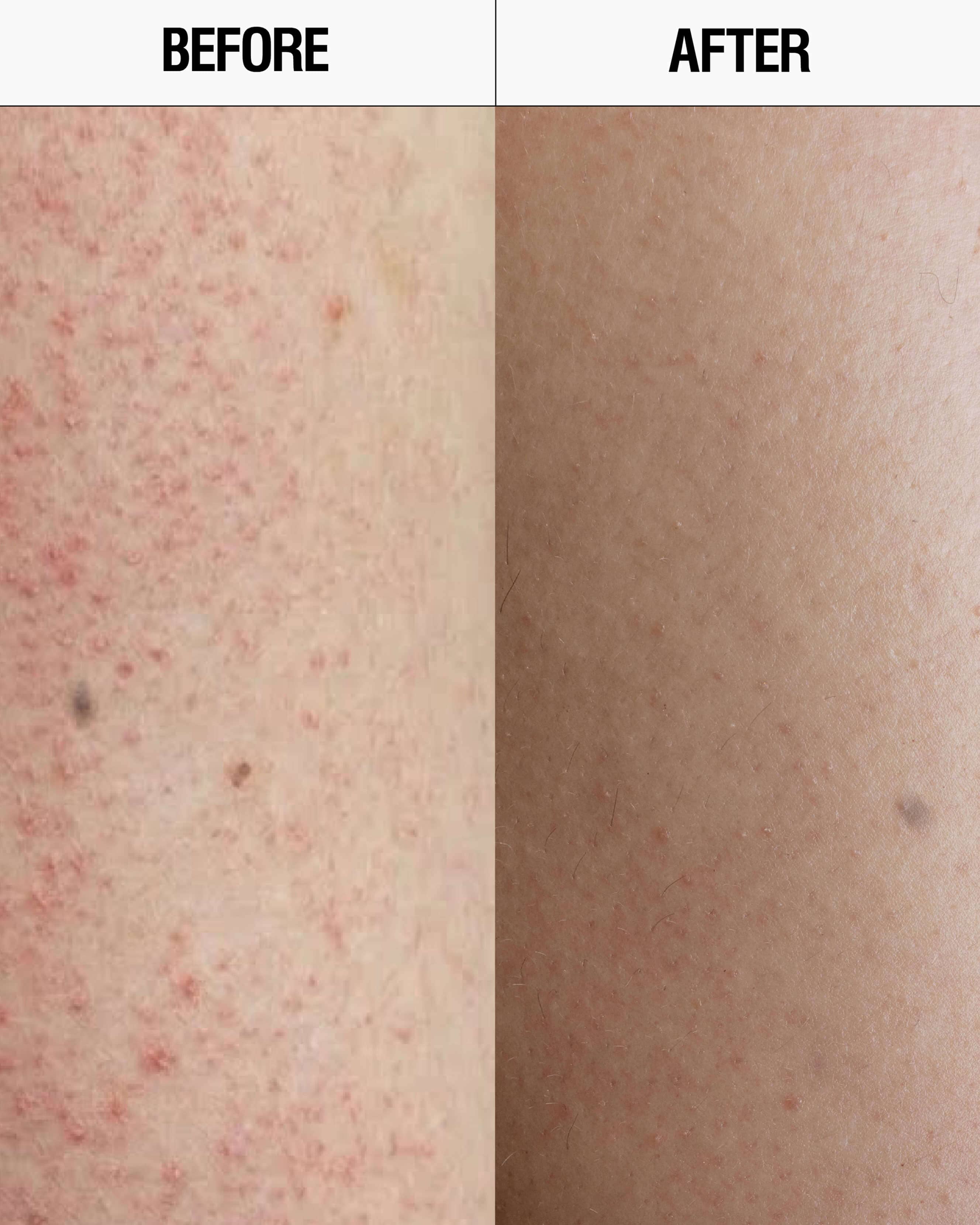 Resurfacing Targeted Body Cleanser